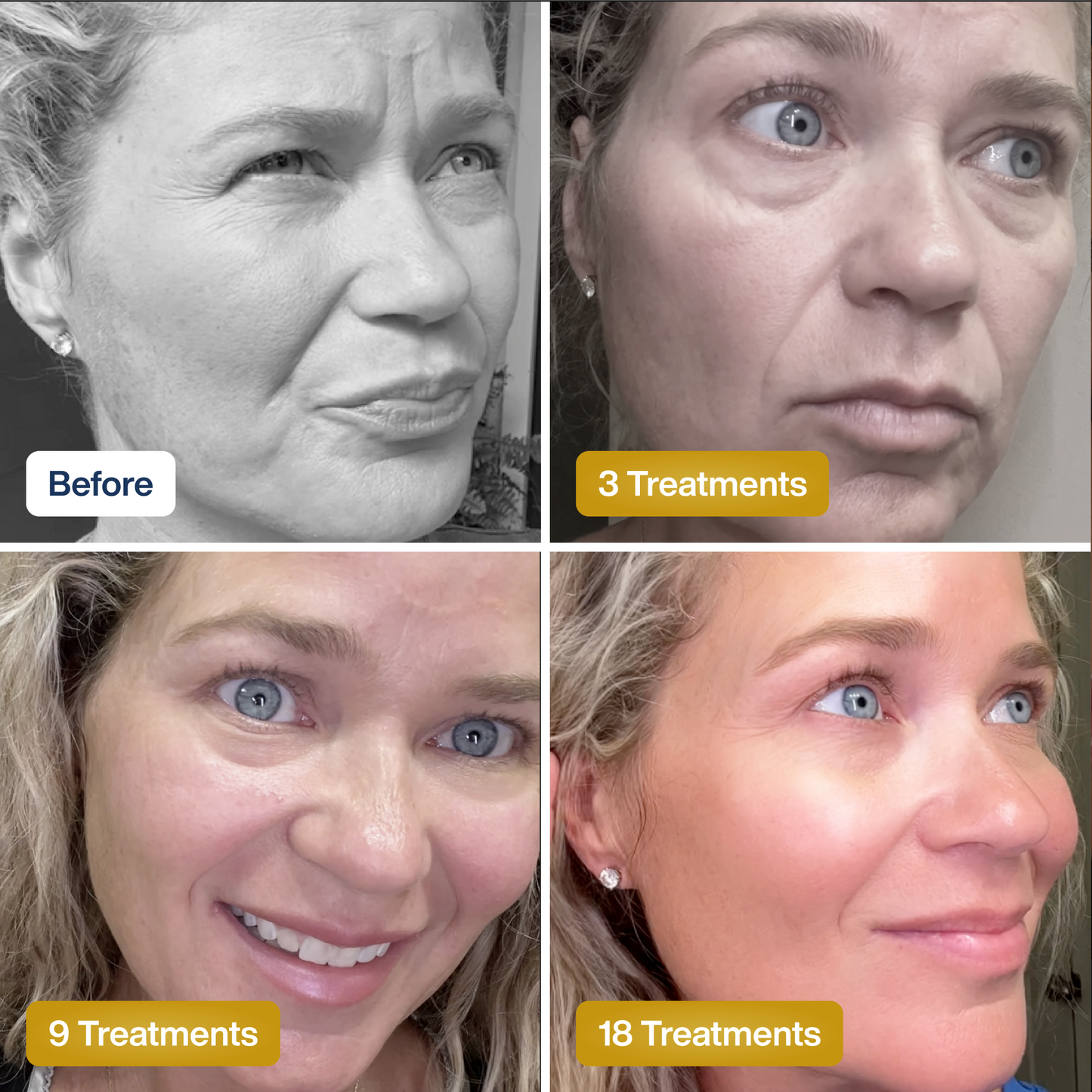 SkinKlean© Collagen Face Mask